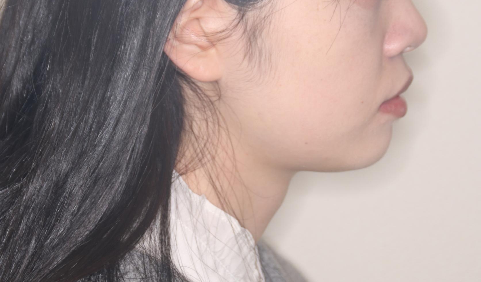 【ワイヤー矯正】前歯の突出感、下の歯の並びを良くしたいの治療前(顔貌)