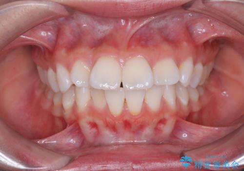 突き出た前歯を下げて理想的な横顔に。上下左右4番抜歯による審美ワイヤー矯正の症例 治療前