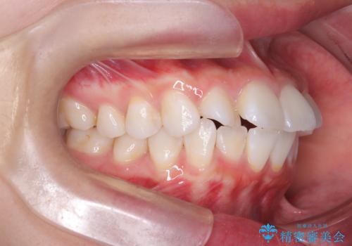 突き出た前歯を下げて理想的な横顔に。上下左右4番抜歯による審美ワイヤー矯正の治療前