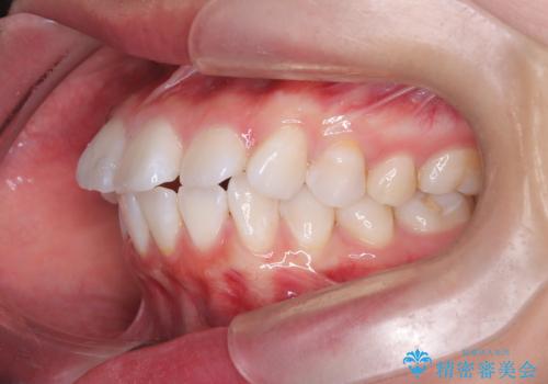 突き出た前歯を下げて理想的な横顔に。上下左右4番抜歯による審美ワイヤー矯正の治療前