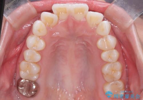 突き出た前歯を下げて理想的な横顔に。上下左右4番抜歯による審美ワイヤー矯正の治療前