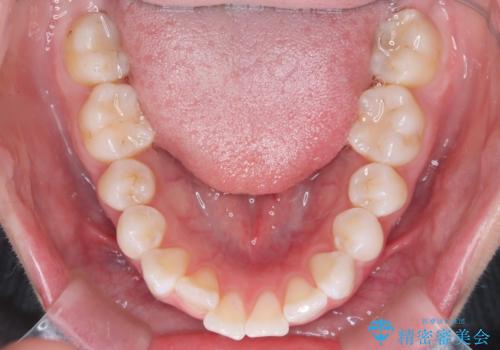 突き出た前歯を下げて理想的な横顔に。上下左右4番抜歯による審美ワイヤー矯正の治療前