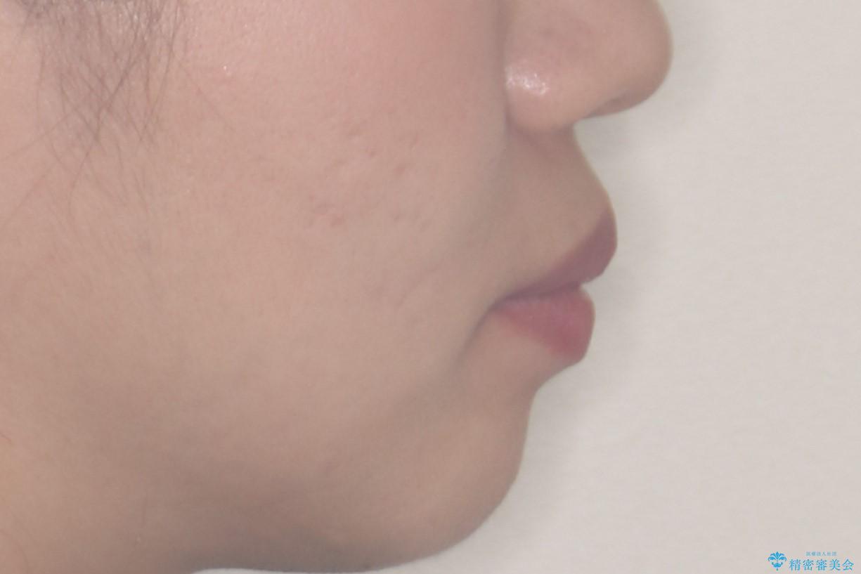 突き出た前歯を下げて理想的な横顔に。上下左右4番抜歯による審美ワイヤー矯正の治療前(顔貌)