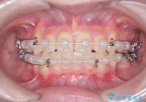 前歯の突出と下顎の偏位を改善。審美ワイヤーで整えるバランスの良い歯並びの治療中