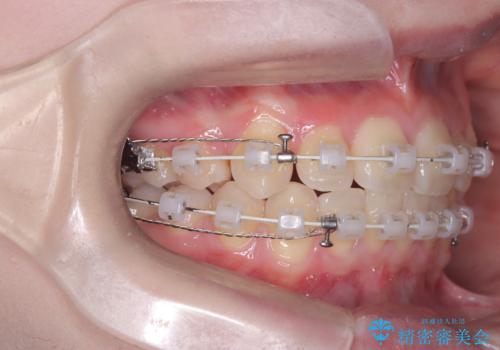 前歯の突出と下顎の偏位を改善。審美ワイヤーで整えるバランスの良い歯並びの治療中