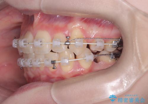 前歯の突出と下顎の偏位を改善。審美ワイヤーで整えるバランスの良い歯並びの治療中