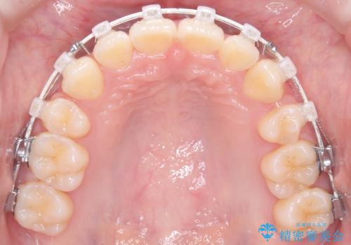 前歯の突出と下顎の偏位を改善。審美ワイヤーで整えるバランスの良い歯並びの治療中