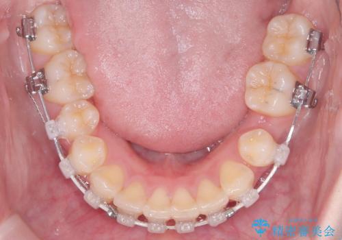 前歯の突出と下顎の偏位を改善。審美ワイヤーで整えるバランスの良い歯並びの治療中