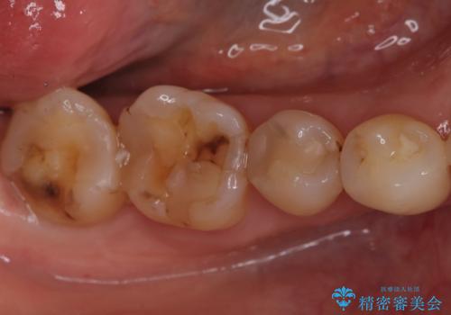 欠けやすい大きなプラスチック充填から、耐久性の高いセラミッククラウンへの症例 治療前