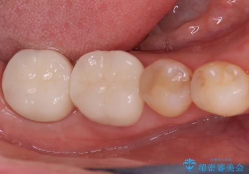欠けやすい大きなプラスチック充填から、耐久性の高いセラミッククラウンへの症例 治療後