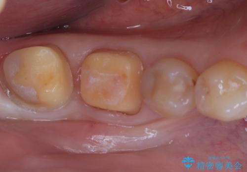 欠けやすい大きなプラスチック充填から、耐久性の高いセラミッククラウンへの治療中