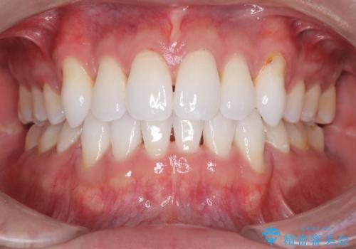 前歯の突出を防ぎながらガタつきを解消。上下左右4番抜歯による審美ワイヤー矯正の症例 治療後