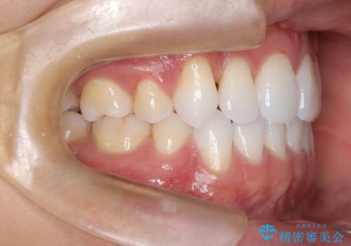 前歯の突出を防ぎながらガタつきを解消。上下左右4番抜歯による審美ワイヤー矯正の治療後
