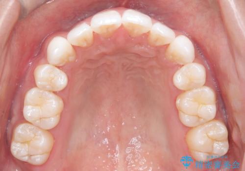 前歯の突出を防ぎながらガタつきを解消。上下左右4番抜歯による審美ワイヤー矯正の治療後