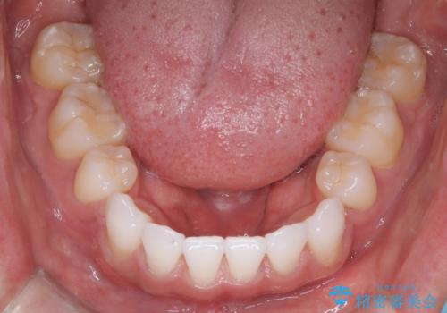 前歯の突出を防ぎながらガタつきを解消。上下左右4番抜歯による審美ワイヤー矯正の治療後