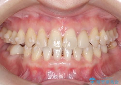 歯の隙間と欠損を同時に解決。インビザラインとインプラントを組み合わせた包括的治療の治療中