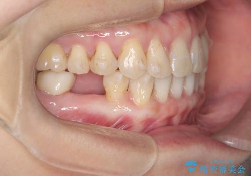 歯の隙間と欠損を同時に解決。インビザラインとインプラントを組み合わせた包括的治療の治療中