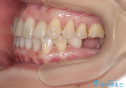 歯の隙間と欠損を同時に解決。インビザラインとインプラントを組み合わせた包括的治療の治療中