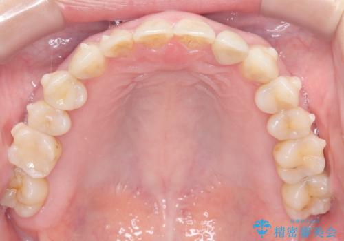 歯の隙間と欠損を同時に解決。インビザラインとインプラントを組み合わせた包括的治療の治療中