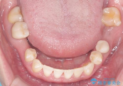 歯の隙間と欠損を同時に解決。インビザラインとインプラントを組み合わせた包括的治療の治療中