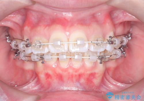 突き出た前歯を下げて理想的な横顔に。上下左右4番抜歯による審美ワイヤー矯正の治療中