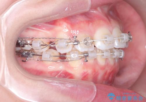 突き出た前歯を下げて理想的な横顔に。上下左右4番抜歯による審美ワイヤー矯正の治療中