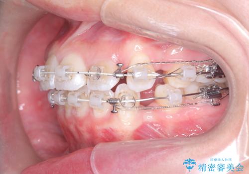 突き出た前歯を下げて理想的な横顔に。上下左右4番抜歯による審美ワイヤー矯正の治療中