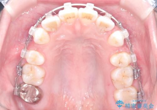 突き出た前歯を下げて理想的な横顔に。上下左右4番抜歯による審美ワイヤー矯正の治療中