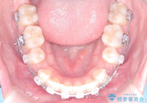 突き出た前歯を下げて理想的な横顔に。上下左右4番抜歯による審美ワイヤー矯正の治療中