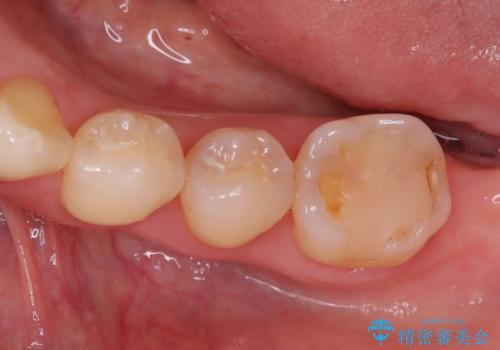 繰り返すプラスチックの欠けを解消。広範囲の修復に適したセラミッククラウンの症例 治療前