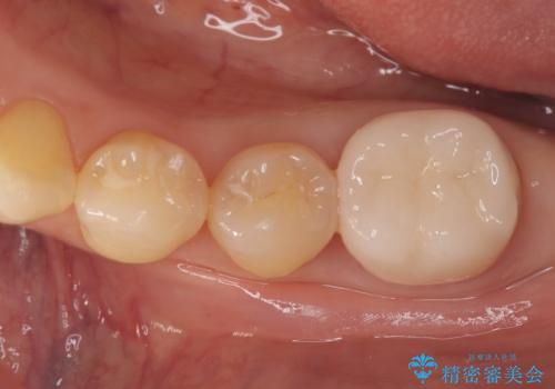 繰り返すプラスチックの欠けを解消。広範囲の修復に適したセラミッククラウンの症例 治療後