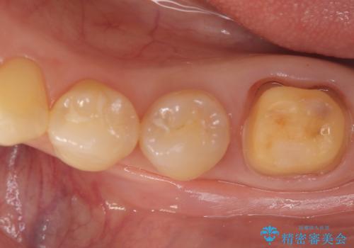 繰り返すプラスチックの欠けを解消。広範囲の修復に適したセラミッククラウンの治療中
