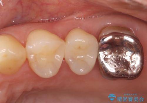 根の病変を精密治療で改善。再発を防ぐ根管治療とオールセラミッククラウンの症例 治療前