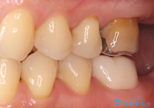 根の病変を精密治療で改善。再発を防ぐ根管治療とオールセラミッククラウンの治療前