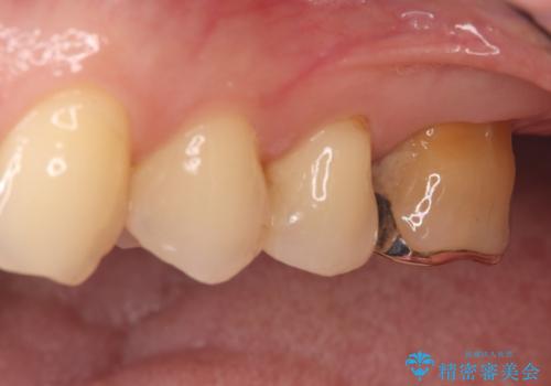 根の病変を精密治療で改善。再発を防ぐ根管治療とオールセラミッククラウンの治療前