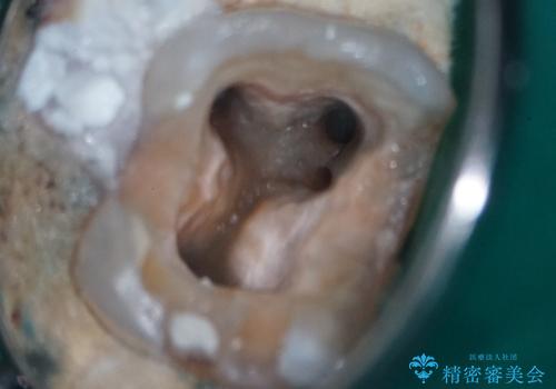 銀歯からセラミックへ。右上奥歯の精密根管治療と審美修復の治療中