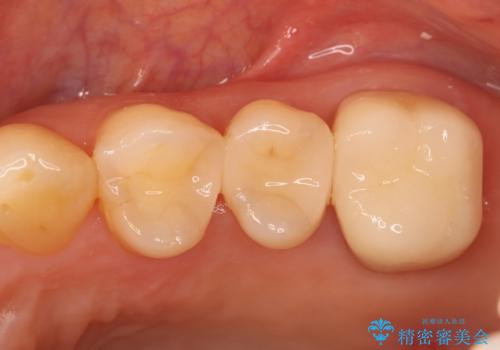 根の病変を精密治療で改善。再発を防ぐ根管治療とオールセラミッククラウン