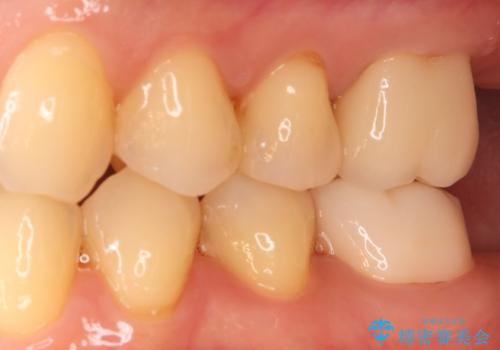 根の病変を精密治療で改善。再発を防ぐ根管治療とオールセラミッククラウンの治療後