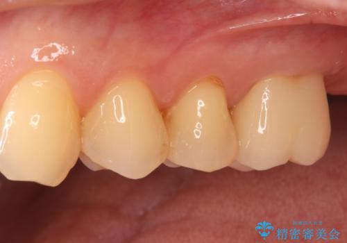 根の病変を精密治療で改善。再発を防ぐ根管治療とオールセラミッククラウンの治療後