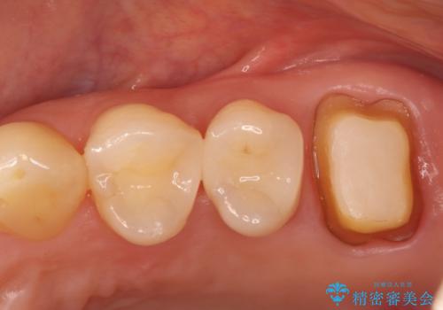 根の病変を精密治療で改善。再発を防ぐ根管治療とオールセラミッククラウンの治療中