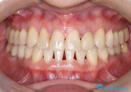 歯の隙間と欠損を同時に解決。インビザラインとインプラントを組み合わせた包括的治療の症例 治療後