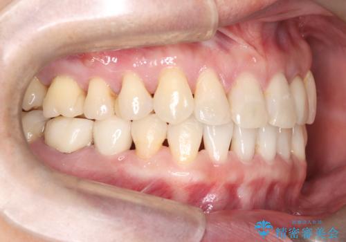 歯の隙間と欠損を同時に解決。インビザラインとインプラントを組み合わせた包括的治療の治療後