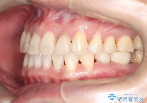 歯の隙間と欠損を同時に解決。インビザラインとインプラントを組み合わせた包括的治療の治療後