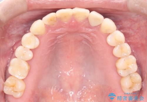 歯の隙間と欠損を同時に解決。インビザラインとインプラントを組み合わせた包括的治療の治療後