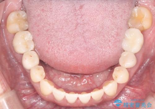 歯の隙間と欠損を同時に解決。インビザラインとインプラントを組み合わせた包括的治療の治療後