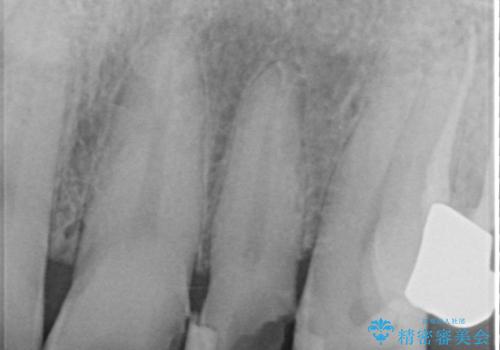前歯のコンプレックスを解消|40代男性・オールセラミッククラウン症例の治療前