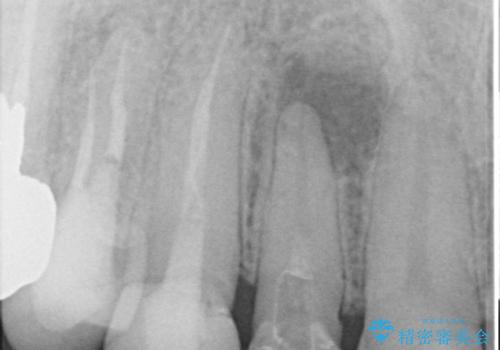 前歯のコンプレックスを解消|40代男性・オールセラミッククラウン症例の治療前