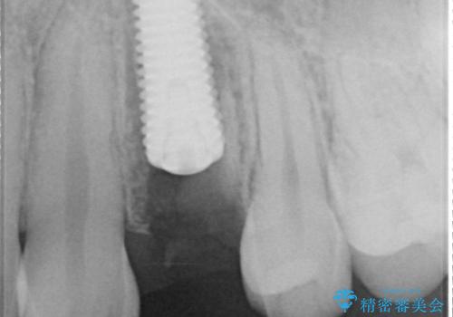 根元から折れてしまった歯をどうする?矯正かインプラントかを比較検討した症例の治療中