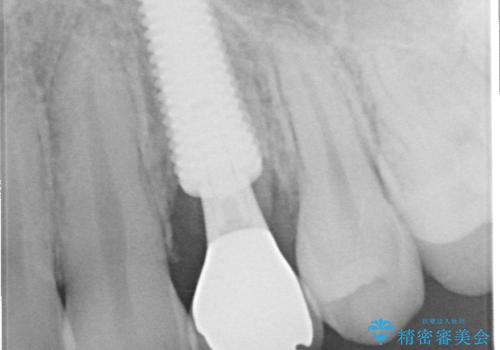 根元から折れてしまった歯をどうする?矯正かインプラントかを比較検討した症例の治療後