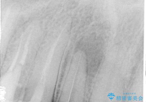 前歯のコンプレックスを解消|40代男性・オールセラミッククラウン症例の治療中